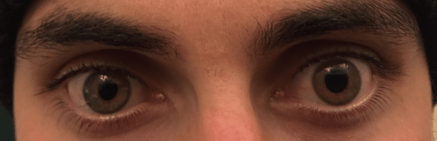 eyes in Horner's syndrome case study