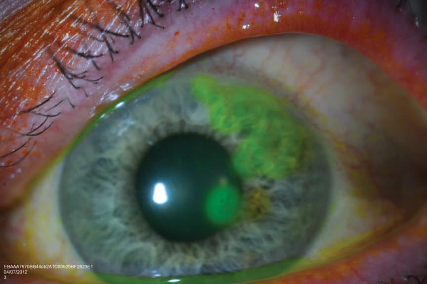herpes-simplex-epithelial-keratitis