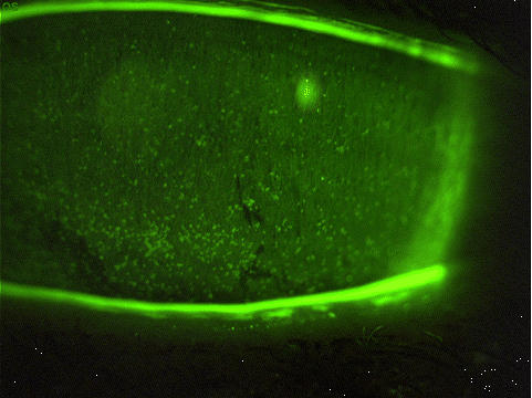 fluorescein stain