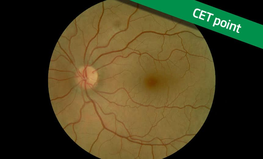 cet-featured-image-Ocular-Anaemia-Diabetes-and-the-eye-part6