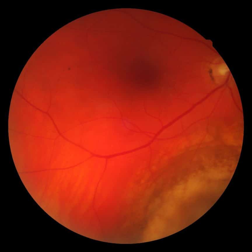 Choroidal melanoma