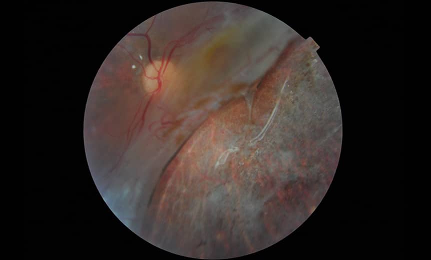 Retinal-detachment_Manminder-Matharu