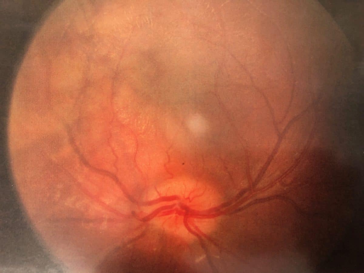 eye symptoms fracture glass eye symptoms fracture glass