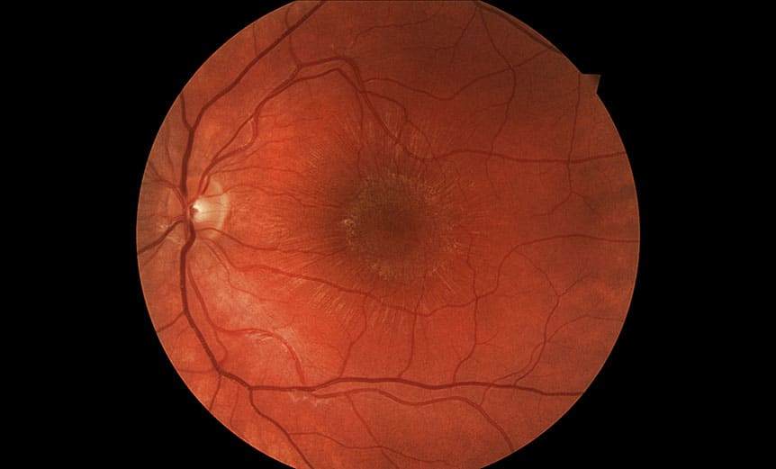 Stellate maculopathy