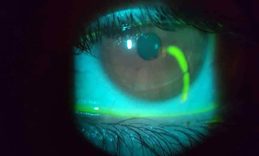 Clinical photography Corneal abrasion Spectrum