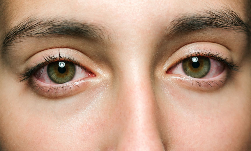 Allergy advice given ahead of 'pollen bomb' hayfever season Spectrum