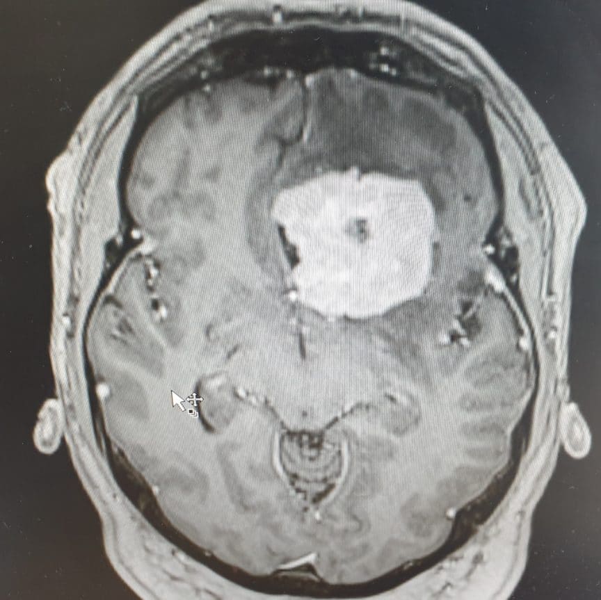 Tennisball sized tumour detected after a routine sight test Spectrum