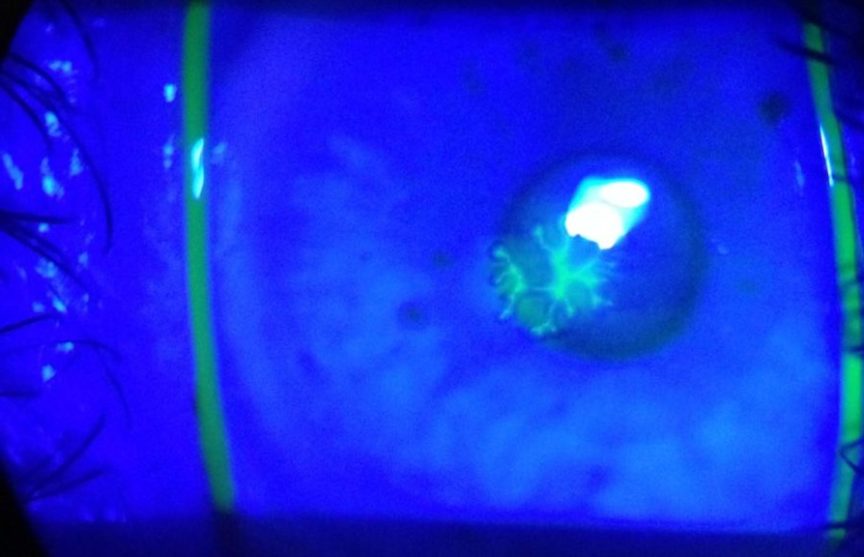 Digital retinal photography of Dendritic ulcer, provided by Greg Braude, Specsavers Sydney