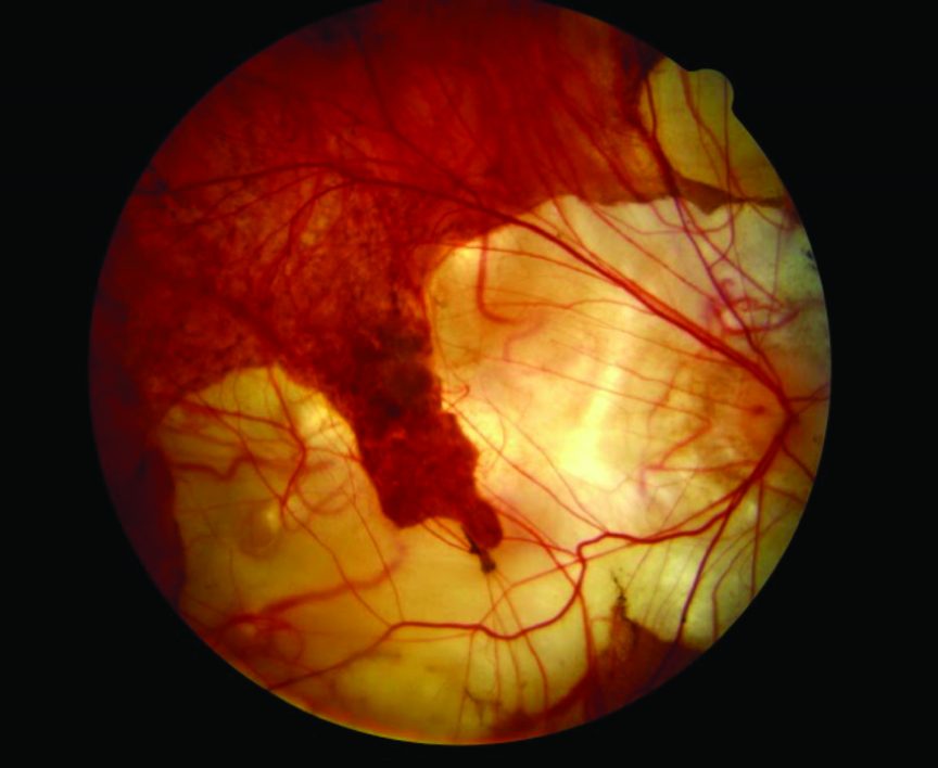 degenerative myopia retina degenerative myopia retina